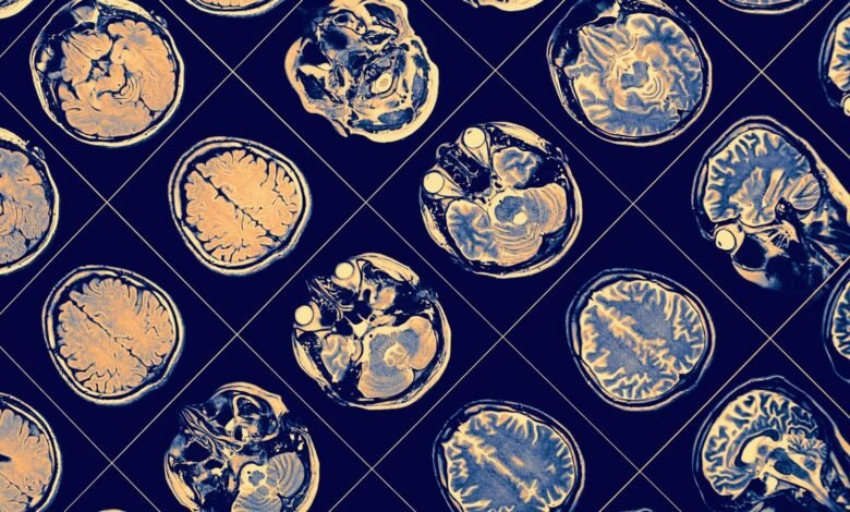 Scientists Announce Possible Breakthrough in Delaying Alzheimers.jpg