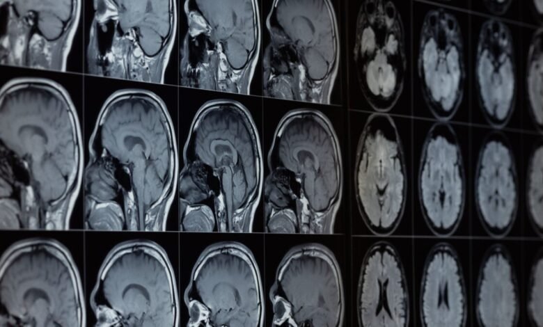 Our Brains Contain Lithium—and Its Loss Might Help Drive Alzheimers.jpg