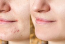 Reviewers Say These 6 Pimple Patches Zapped Zits Overnight.jpg