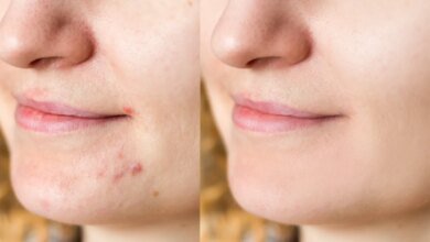 Reviewers Say These 6 Pimple Patches Zapped Zits Overnight.jpg